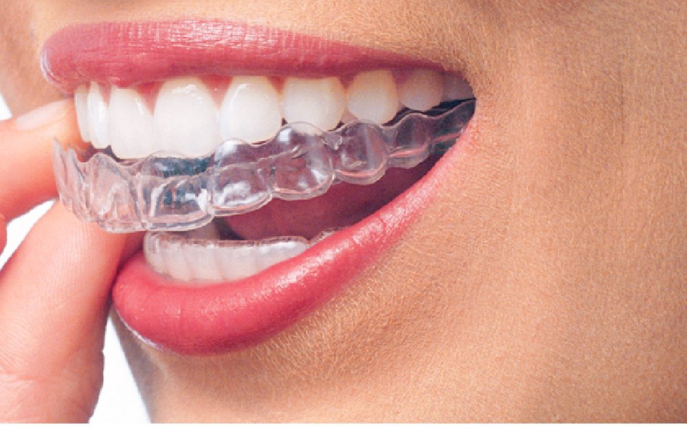 Invisalign First  Dr. Patricia Timmeny